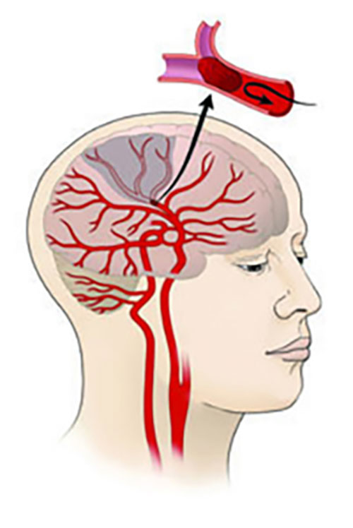 Illustration of an ischemic stroke